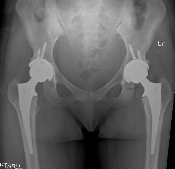 Radiograph showing bilateral total hip replacements