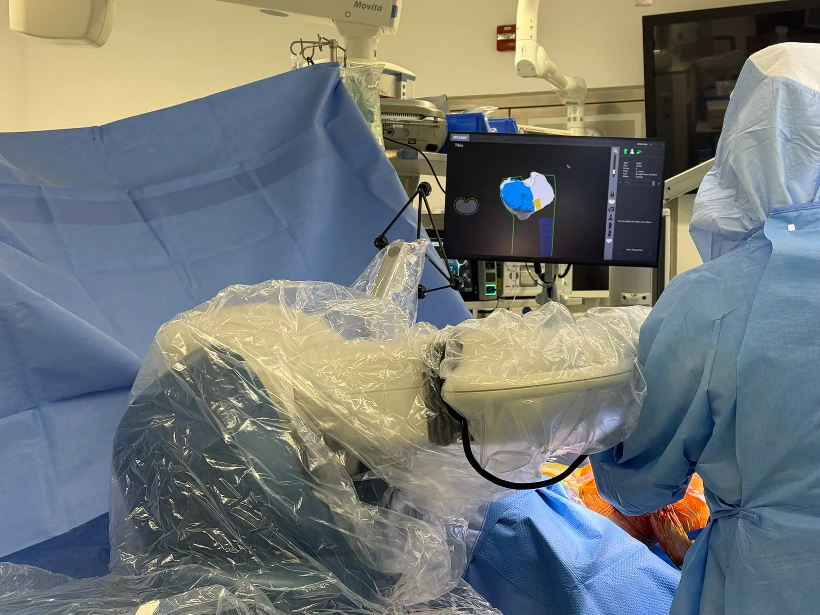 Stryker Mako robotic arm positioned in theatre with the intra-operative navigation display