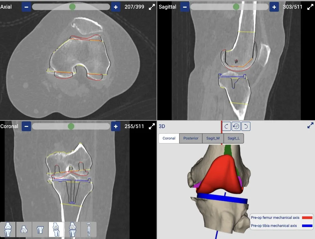 CT-based patient-specific knee replacement planning in axial, sagittal, coronal and 3D views