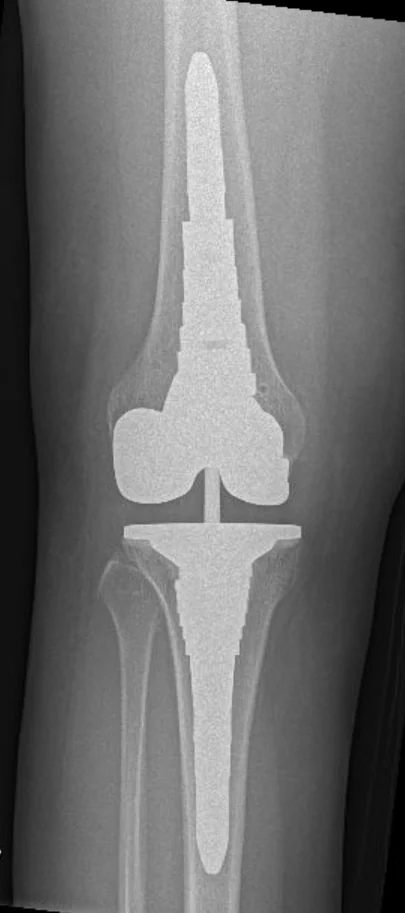 Radiograph of a revision total knee replacement with long-stem femoral and tibial components