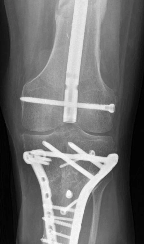 Radiograph of internal fixation with an intramedullary nail and periarticular plate construct
